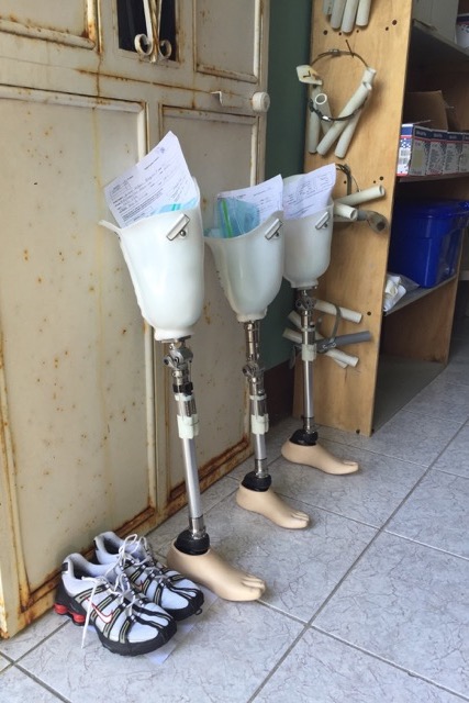 Donate - Above the Knee Prosthesis